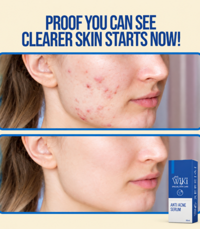 Wiki Special Anti Acne Serum 30ml for acne-prone skin