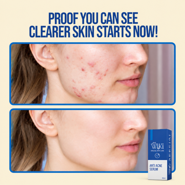 Wiki Special Anti Acne Serum 30ml for acne-prone skin